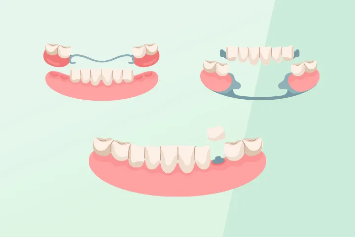 イメージ：歯の治療の種類